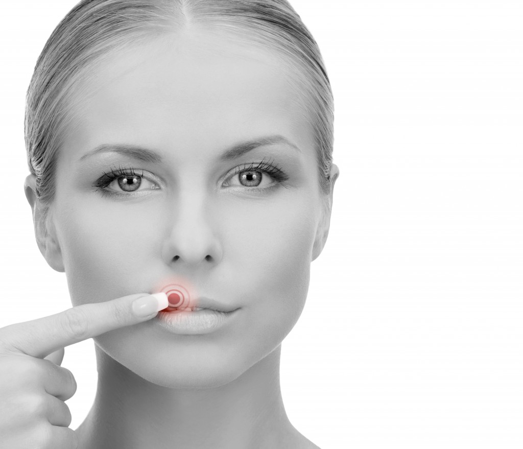 Treating Cold Sores Naturally treating-cold-sores-naturally