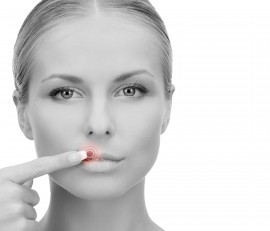 cold sore treatment natural cold sore remedy